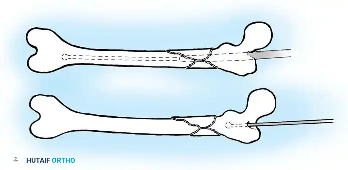 Hutaifortho's Orthopaedic Diagram