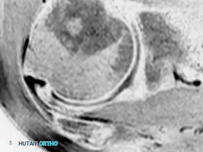 صورة رنين مغناطيسي للكتف مع تقنية قمع الدهون تظهر تمزقا كاملا في وتر الكفة المدورة بوضوح