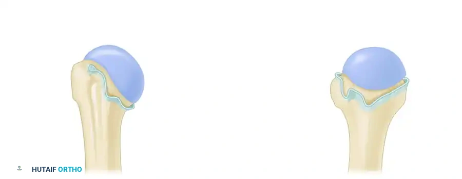 مرفقات الأربطة الحقية العضدية على عظمة العضد