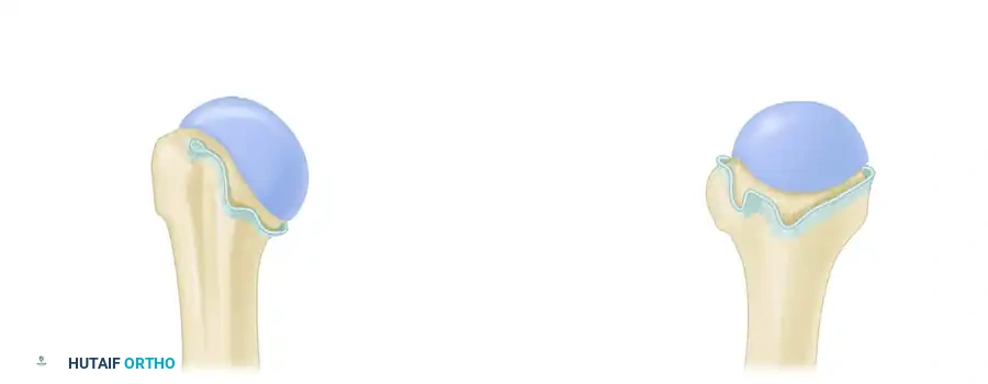 المنظر الجانبي لمرفقات الأربطة على عظمة العضد