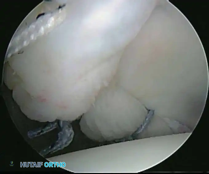 Repaired rotator cuff/labrum