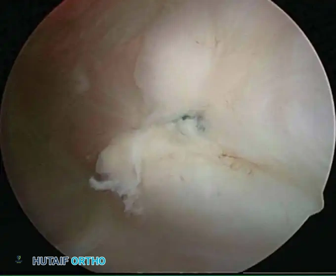 Arthroscopic view of labrum