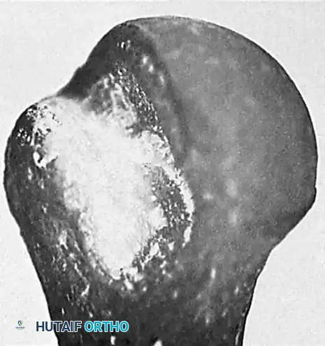 FIGURE 61-13 Pseudoarticulation (arrows) of humeral head with anterior aspect of glenoid cavity in chronic anterior dis location of shoulder. A, Acromion; C, coracoid process. (From Kirt land S, Resnick D, Sartoris D, et al: Chronic, unreduced dislocations of the glenohumeral joint: imaging strategy and pathologic correlation, J Trauma 28:1622, 1988.)