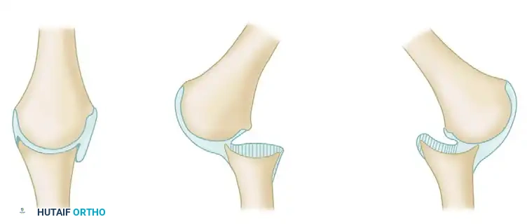 FIGURE 61-11 Relationships in unreduced dislocations of shoulder. A, Normal relationship of humeral head and glenoid cavity. B, In old anterior dislocation, adhesions of posterior capsule to glenoid surface develop. C, In old posterior dislocation, adhesions of anterior capsule to glenoid surface develop. (From Neviaser JS: Arthrography of the shoulder: the diagnosis and management of the lesions visualized , Springfield, IL, 1975, Charles C Thomas.)