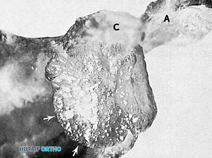 FIGURE 61-12 Large wedge-shaped defect in posterolateral aspect of humeral head in chronic anterior dislocation. (From Kirtland S, Resnick D, Sartoris D, et al: Chronic, unreduced dislocations of the glenohumeral joint: imaging strategy and pathologic correlation, J Trauma 28:1622, 1988.)