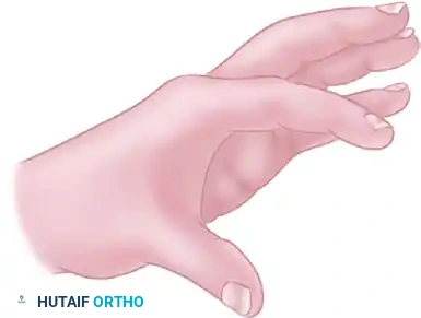 الدليل الشامل لجراحة توسيع المسافة بين الإبهام والسبابة لعلاج انكماش الجلد
