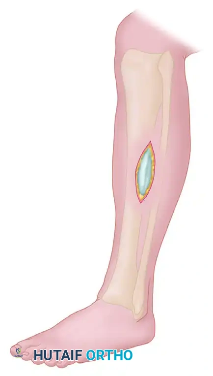 Anterolateral intermuscular septum