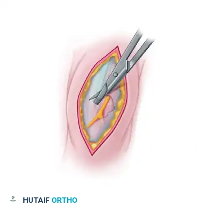 Anterolateral intermuscular septum