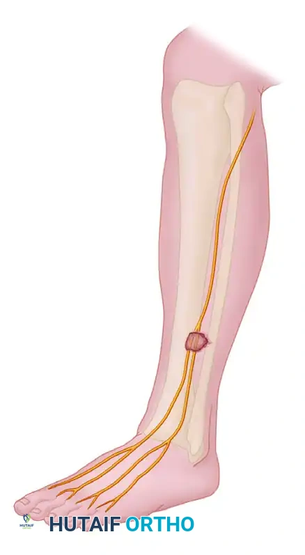Anterolateral intermuscular septum
