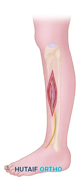SINGLE-INCISION FASCIOTOMY Surgical Diagram