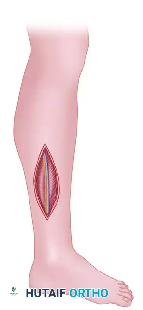 SINGLE-INCISION FASCIOTOMY Surgical Diagram