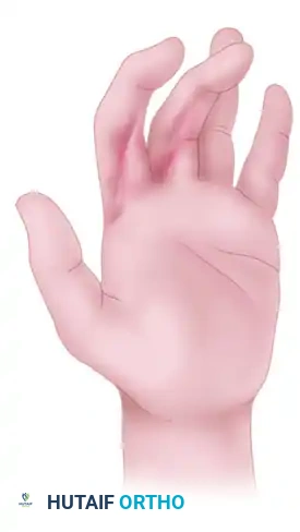 Z-plasty release of linear scar