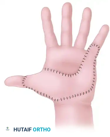 Area scar on the palm