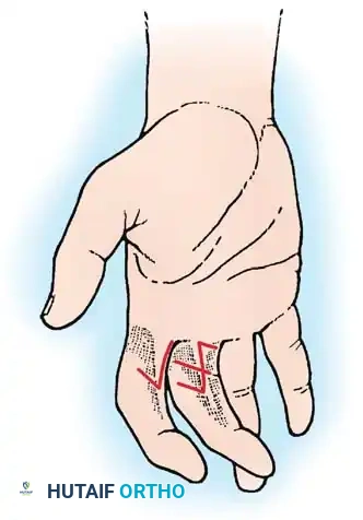 Mastering Skin Coverage in the Hand: Grafts, Flaps, and Scar Reconstruction