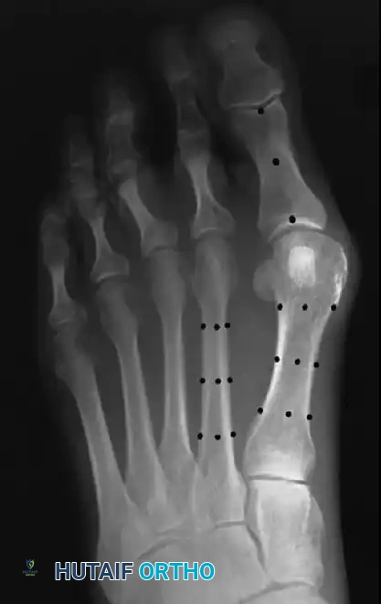 FIGURE 81-8 Hallux valgus treated by modified McBride procedure. A, Preoperative deformity in 30-year-old patient. B, Correction obtained at surgery. C, Preoperative and postoperative radiographs (note fibular sesamoid was not removed). More deformity can be corrected by fibular sesamoidectomy, but overcorrection (hallux varus) is risk. If fibular sesamoid is excised, medial capsule should be closed while holding hallux in 5 to 10 degrees valgus and kept in that position until capsular healing.