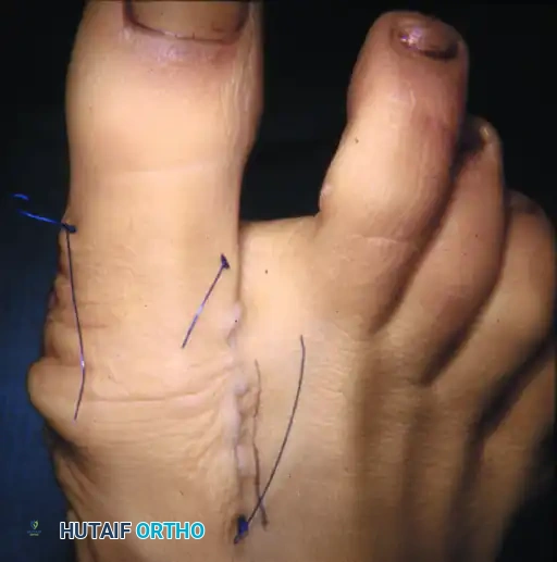 Preoperative radiographic evaluation demonstrating the hallux valgus complex.