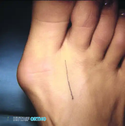 Preoperative marking of the preferred medial incision line.