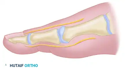 Modified McBride procedure. Longitudinal capsular incision is 3 to 4 mm plantar to skin incision.