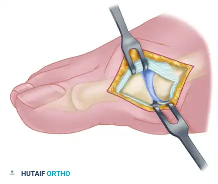 Modified McBride procedure: first incision. Dotted line denotes dorsally curved incision; solid line indicates preferred incision (internervous plane).