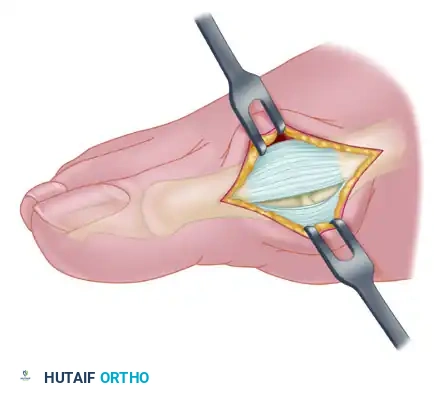 Modified McBride procedure. Capsule is opened, and attachment of capsule on metatarsal neck (arrow) is carefully preserved.