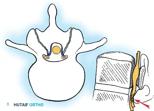 SPINAL STENOSIS Surgical Diagram