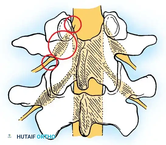 SPINAL STENOSIS Surgical Diagram