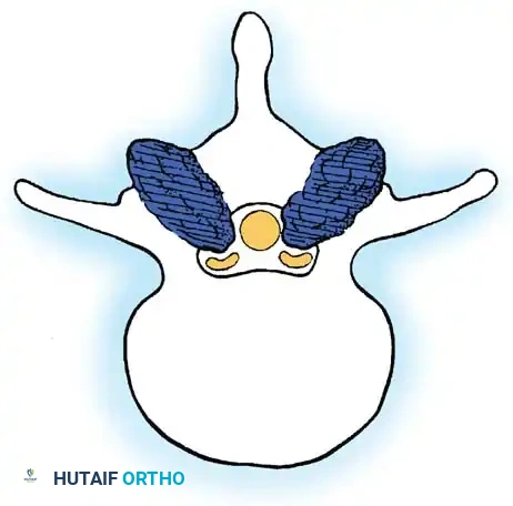 Lumbar Spinal Stenosis: Comprehensive Pathoanatomy and Surgical Management