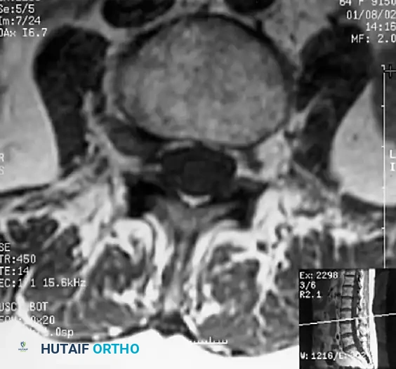 SPINAL STENOSIS Surgical Diagram