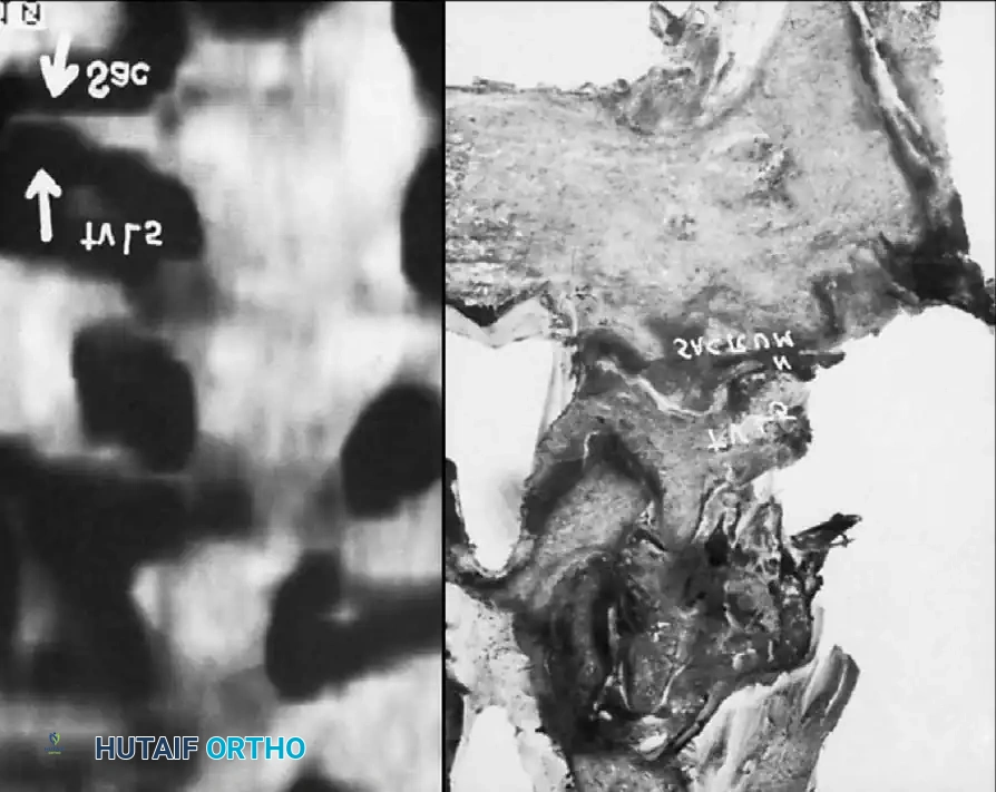 SPINAL STENOSIS Surgical Diagram
