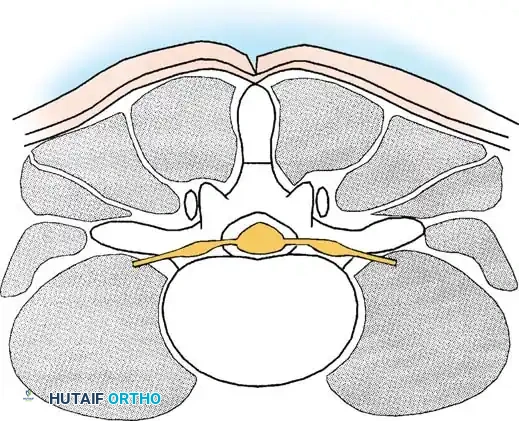 SPINAL STENOSIS Surgical Diagram
