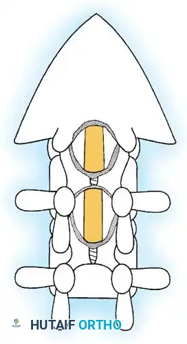 SPINAL STENOSIS Surgical Diagram