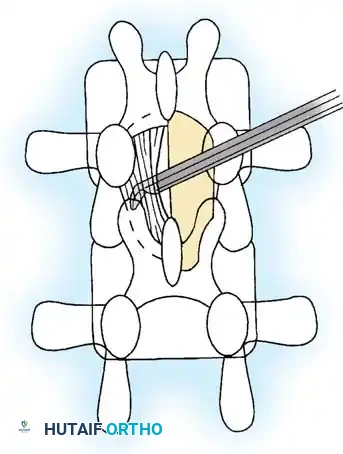 SPINAL STENOSIS Surgical Diagram