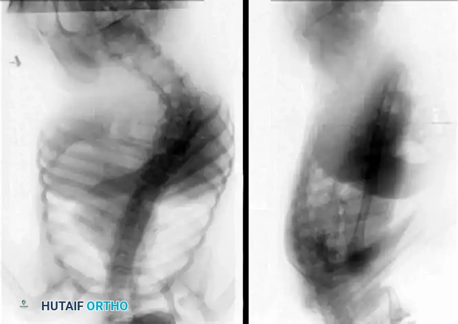 Fig. 30-43 A, Posteroanterior view of spine of patient with spastic quadriplegic cerebral palsy with 73-degree thoracolumbar scoliosis and pelvic obliquity. B, Lateral view of spine of same patient shows progressive lumbar lordosis. This deformity was believed to contribute to increased skin pressures and seating diffi culties. (From McCarthy JJ, D’Andrea LP, Betz RR, et al: Scoliosis in the child with cerebral palsy, J Am Acad Orthop Surg 14:367, 2006.)