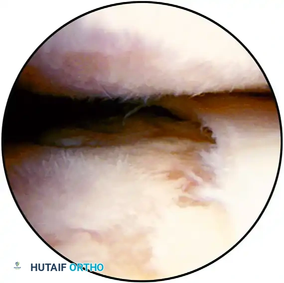SPINOGLENOID CYST Surgical Diagram