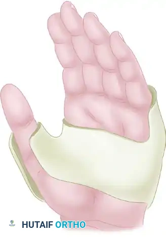 Orthopaedic Splinting: Advanced Principles, Biomechanics, and Surgical Techniques