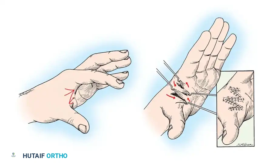 Masterclass in Orthopaedic Splinting and Contracture Management