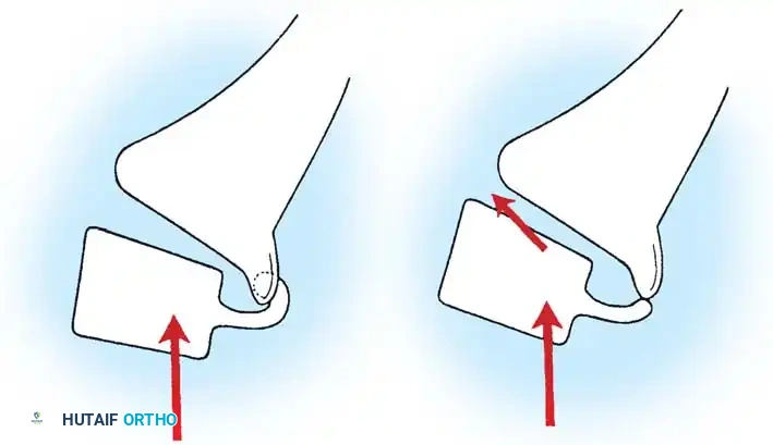 SPONDYLOLYSIS AND SPONDYLOLISTHESIS Surgical Diagram