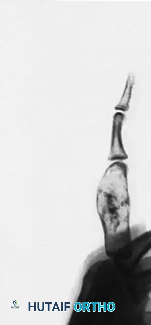 SQUAMOUS CELL CARCINOMA Surgical Diagram