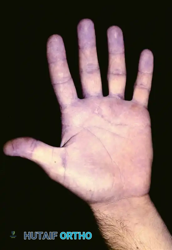 SQUAMOUS CELL CARCINOMA Surgical Diagram