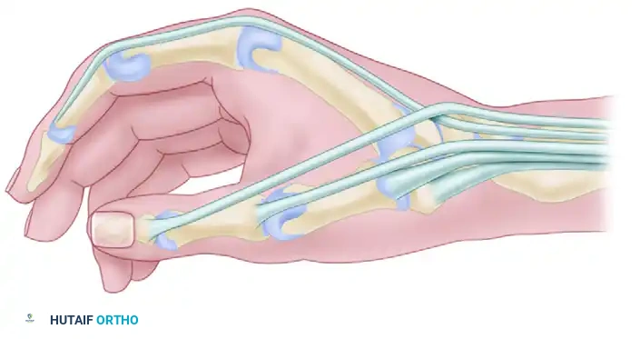 Stenosing Tenosynovitis and De Quervain Disease: A Surgical Masterclass