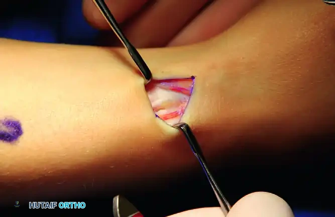 Separate compartments are found for extensor pollicis brevis and abductor pollicis longus tendons