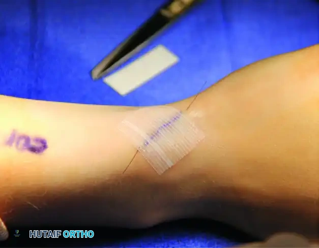 Dorsal carpal ligament has been exposed