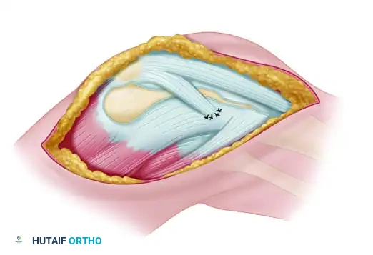 Lateral one-quarter strip of patellar tendon is developed
