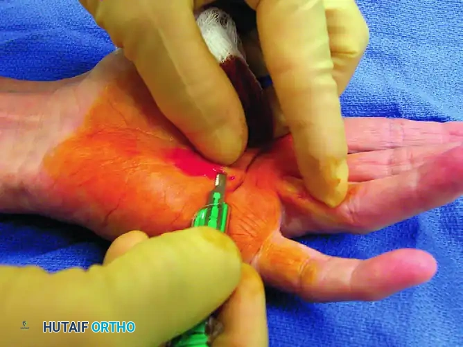 SUBCUTANEOUS FASCIOTOMY Surgical Diagram