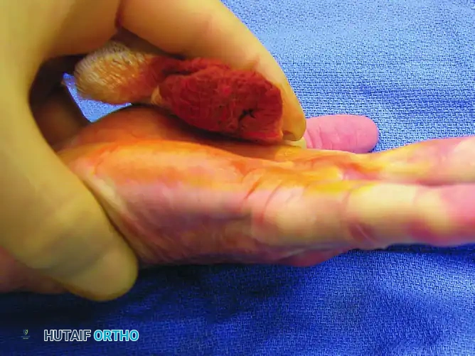 SUBCUTANEOUS FASCIOTOMY Surgical Diagram