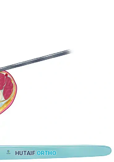 SUBCUTANEOUS FASCIOTOMY Surgical Diagram