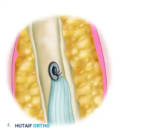 Krackow Sutures Woven into Proximal Tendon