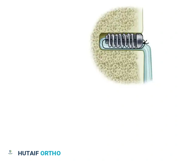 Placement of Interference Screw