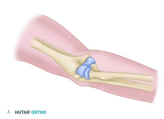 Two-Incision Technique - Incisions