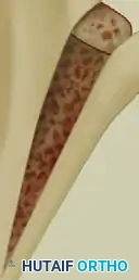 Grade III/IV Chondromalacia